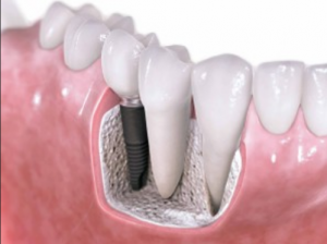 Dental Implants Treatments