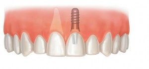 Dental Implant Scenarios
